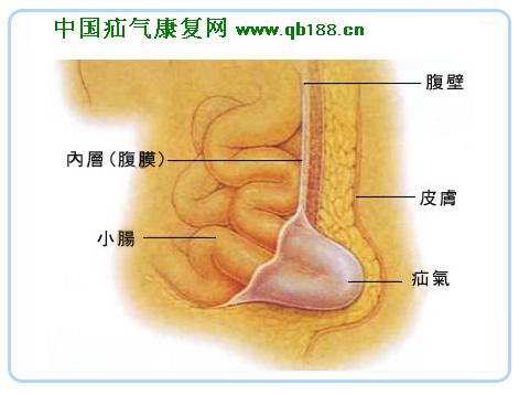 疝气是什么