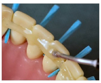 高强纤维（牙周夹板、正畸保持器、根管桩）