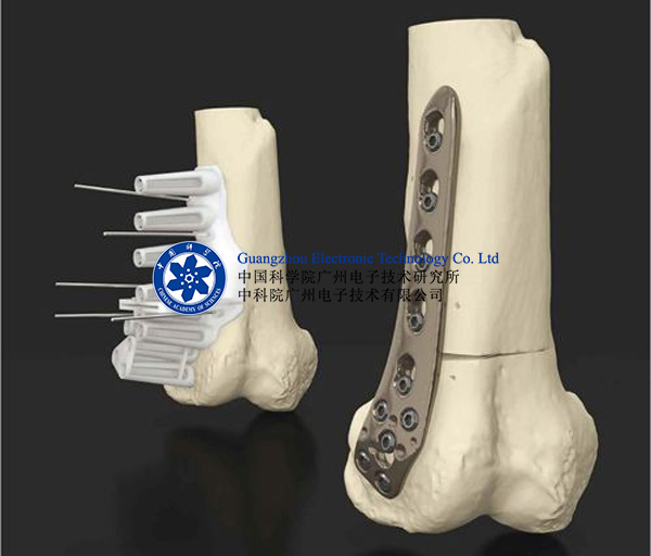 医疗假肢矫正器手术研究3D打印机
