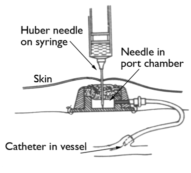 Huber注射针